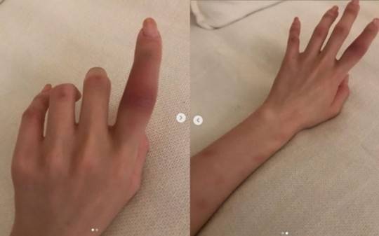 アザが出来て腫れている指の写真